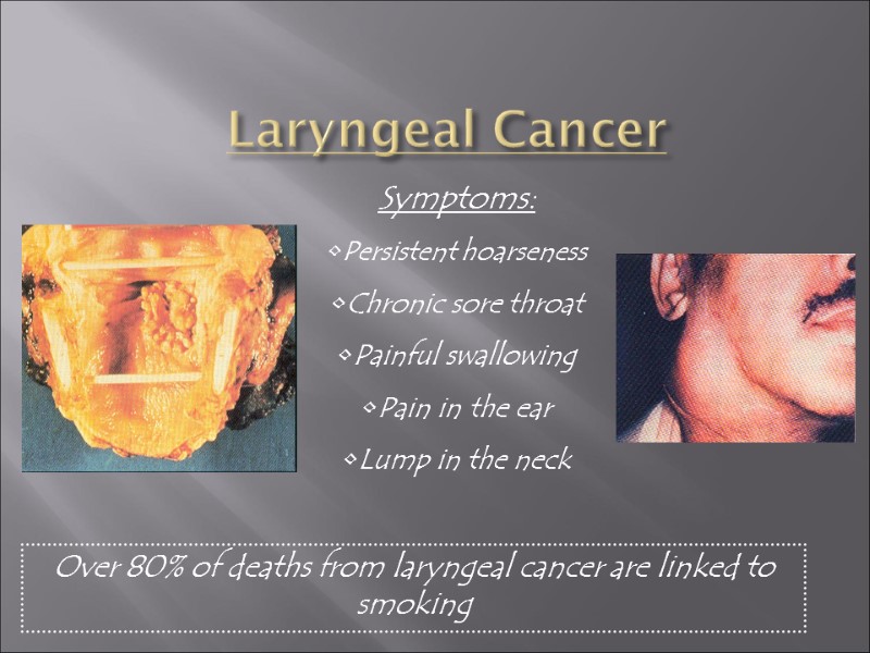 Laryngeal Cancer Symptoms: Persistent hoarseness Chronic sore throat Painful swallowing Pain in the ear